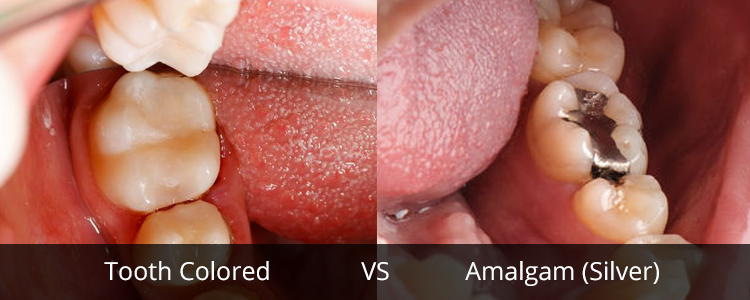 Tooth Colored vs Amalgam Fillings